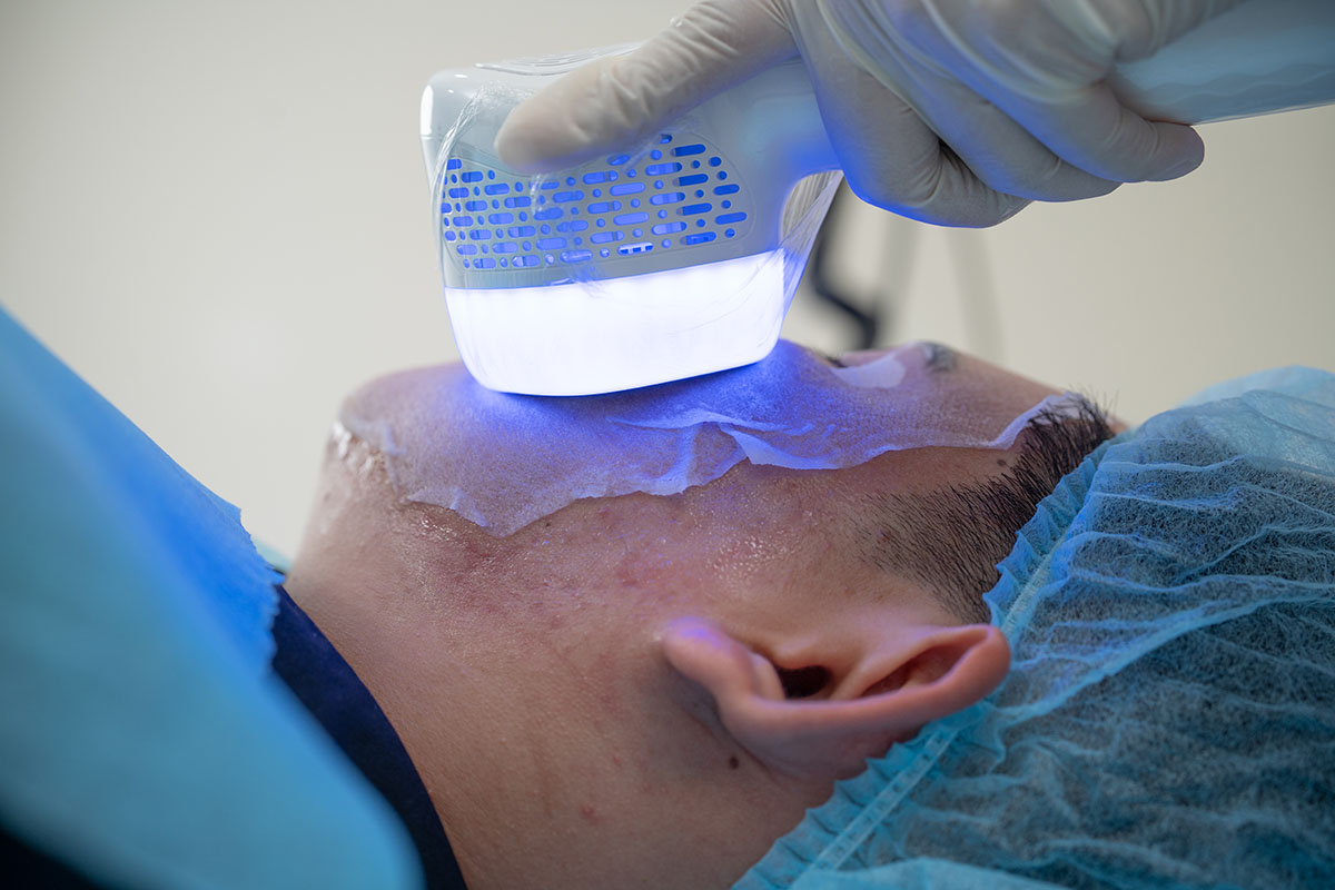 TCA Cross Peel
