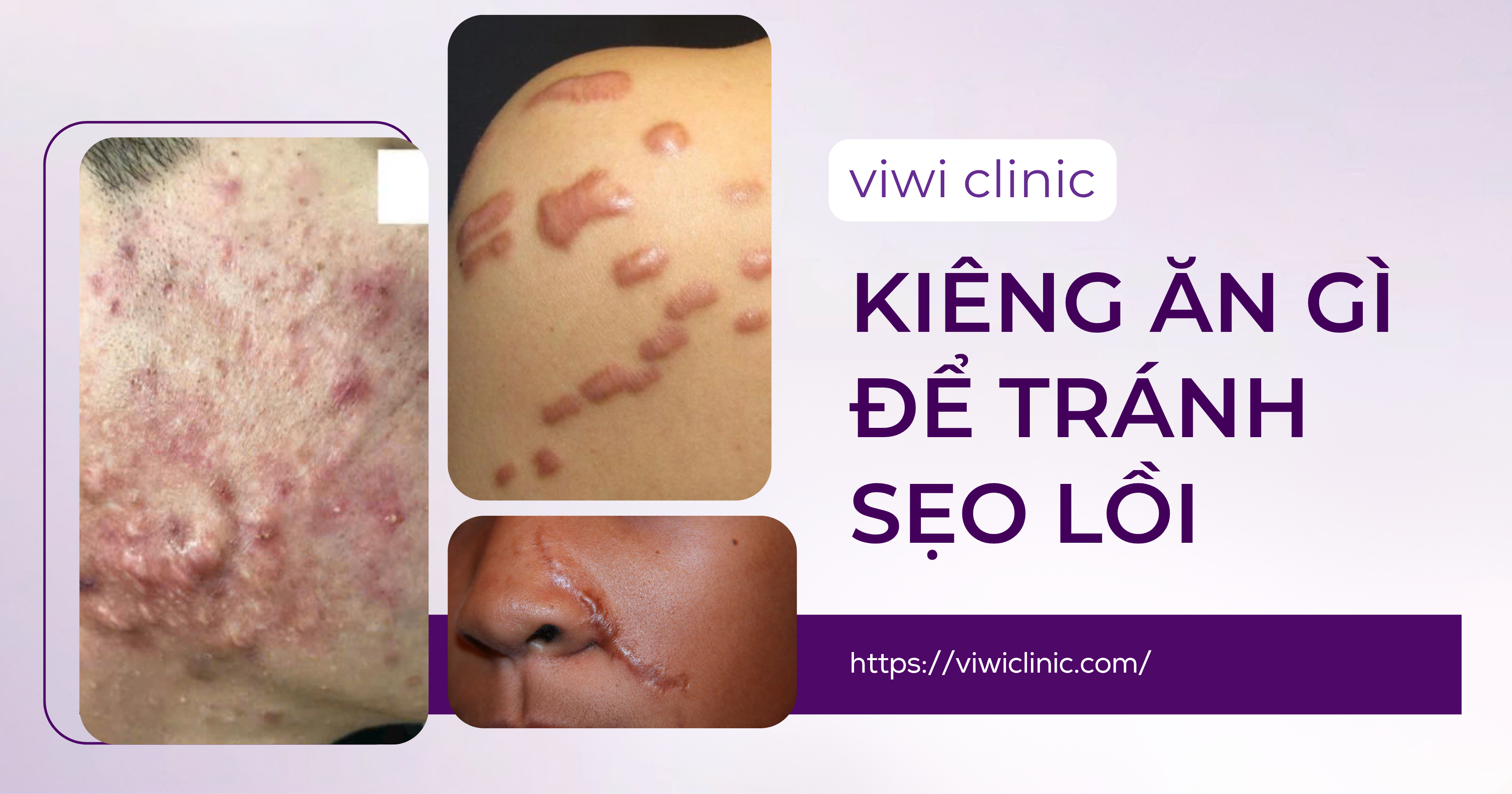 Kiêng ăn gì để tránh sẹo lồi