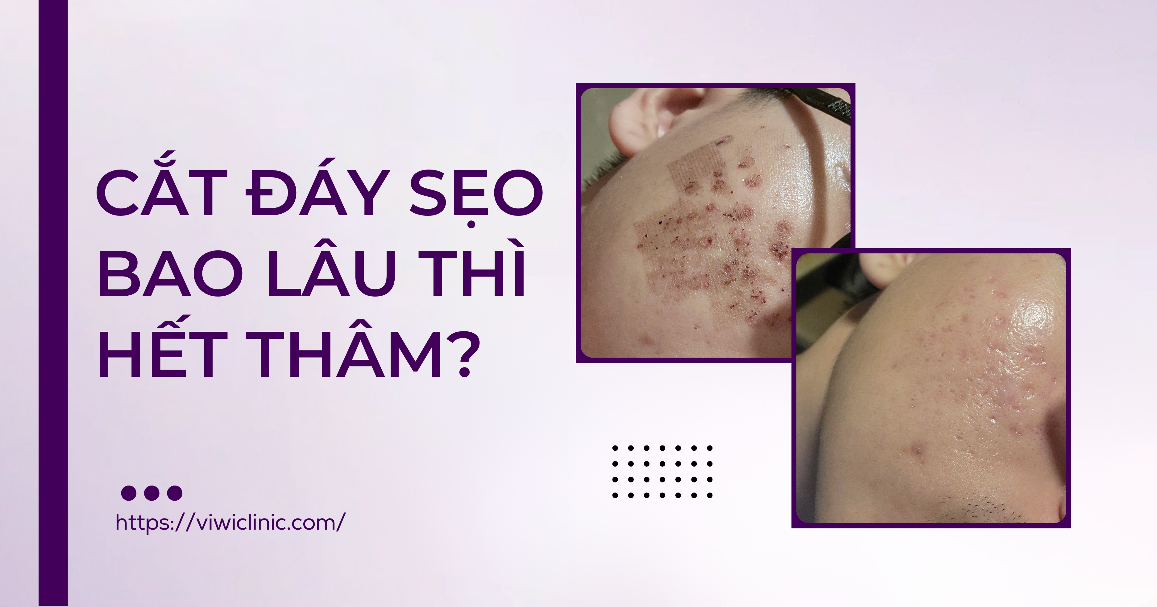Cắt đáy sẹo bao lâu thì hết thâm