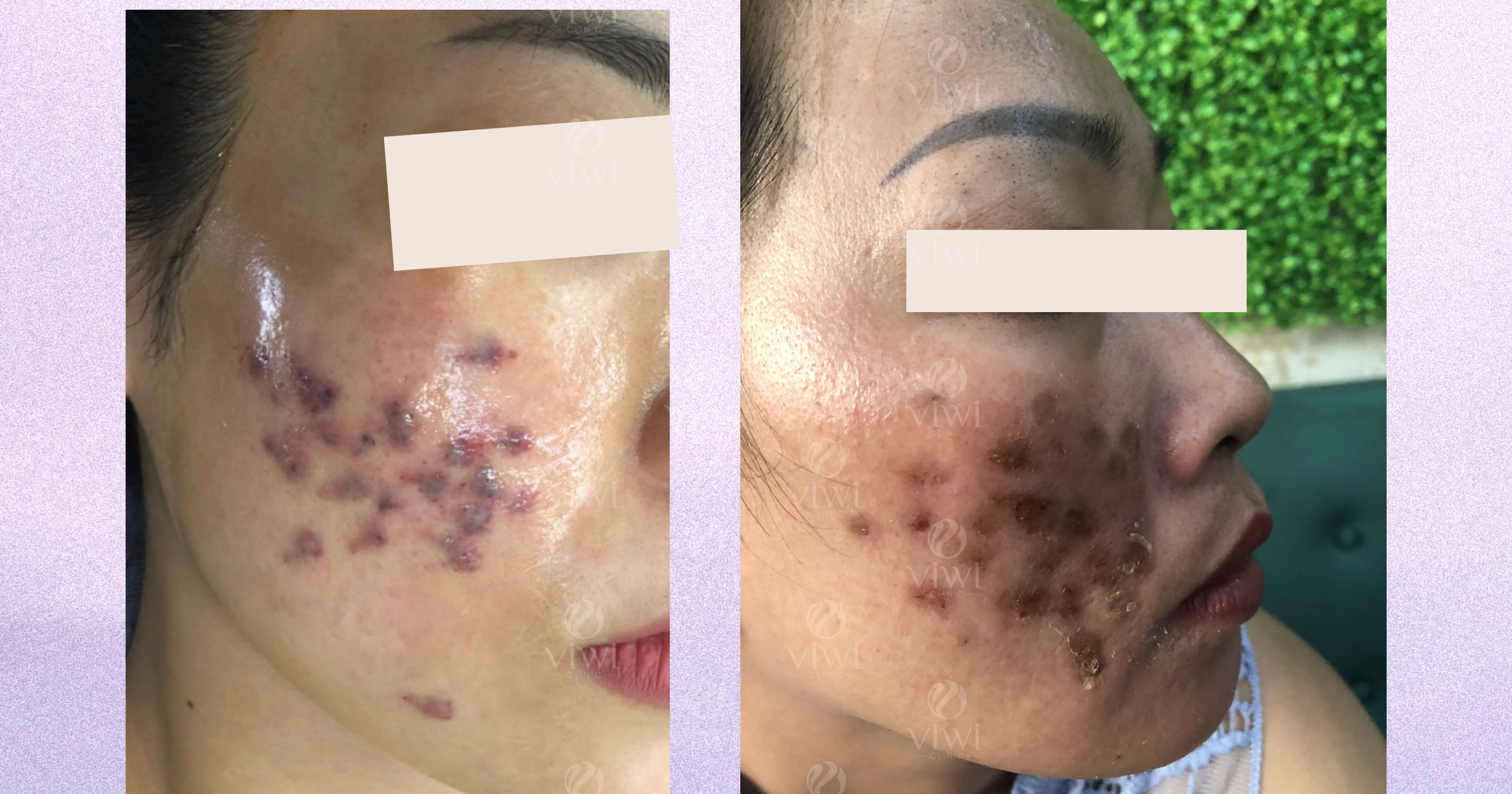 trị thâm sau khi cắt đáy sẹo