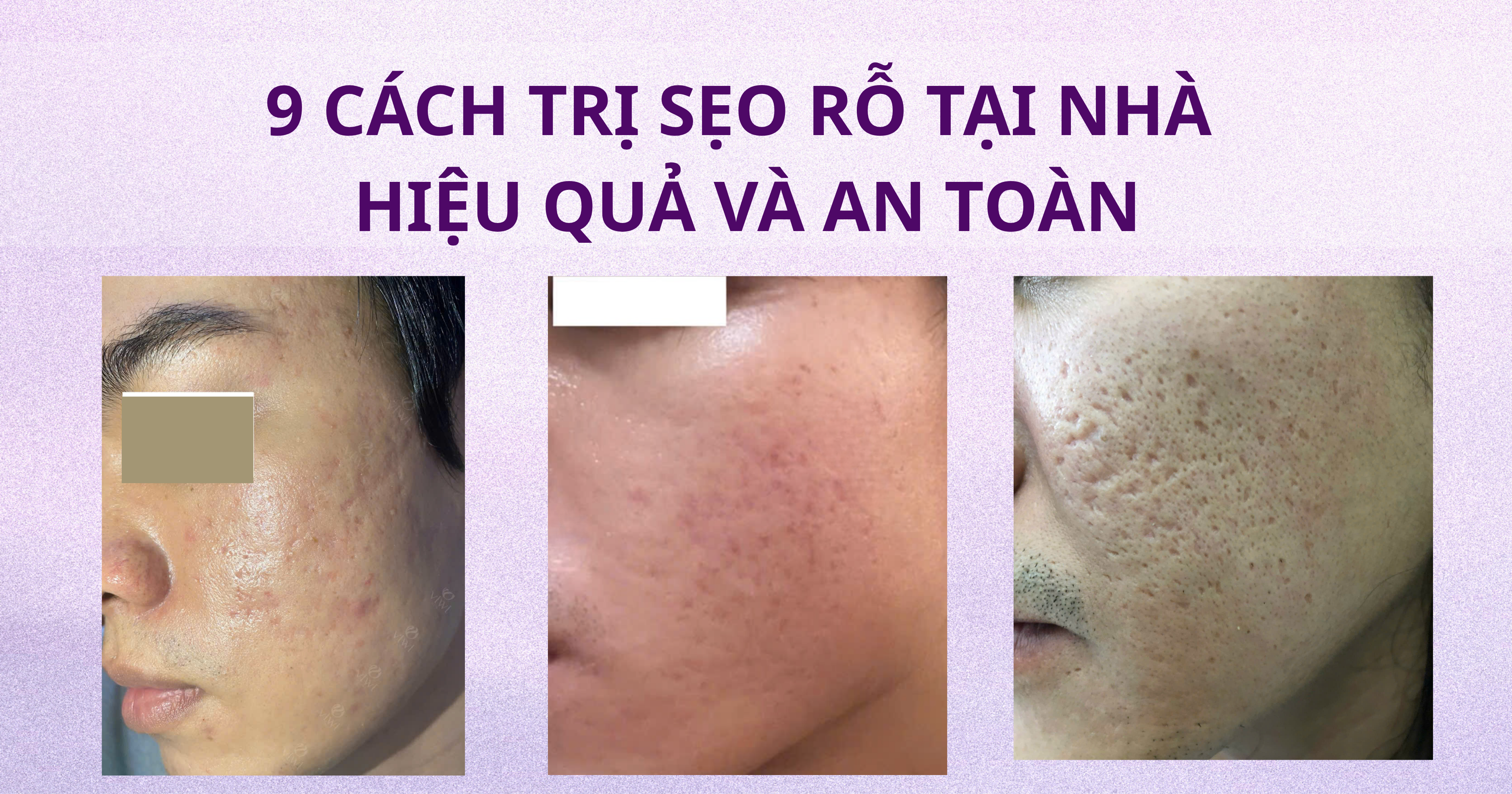 Trị sẹo rỗ tại nhà